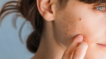 Woman with acne breakout