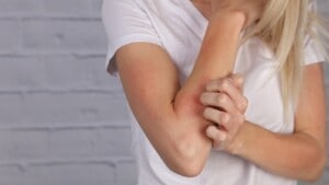 Eczema: 5 effective home remedies worth trying!