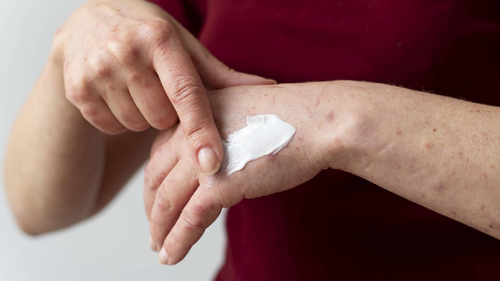 A woman putting ointment on her hand