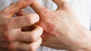 Psoriasis treatment