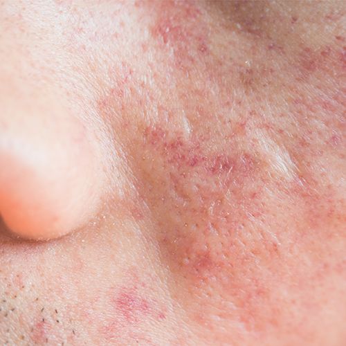 Closeup of red, sensitive skin