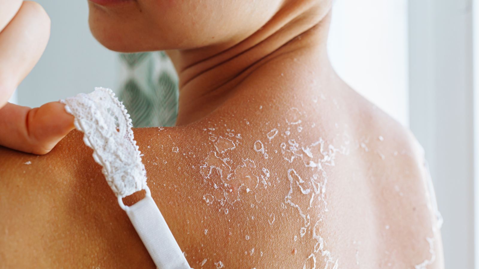 peeling sunburn home remedies